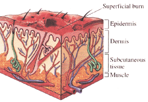1st Degree Burn