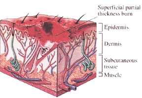 2nd Degree Burn