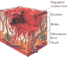 3rd Degree Burn